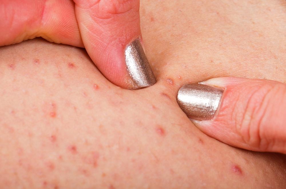 Bye-Bye Razor Burn: The Best Methods for Silky Smoothness
