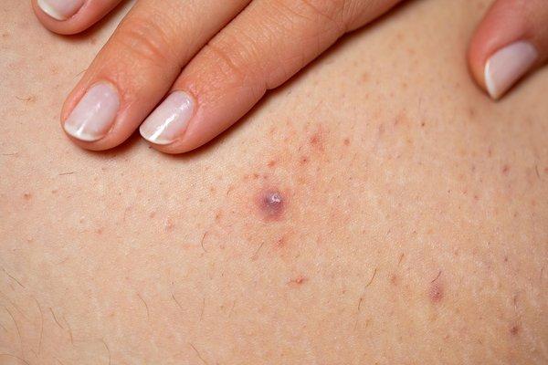 Expert Tips: Avoiding ⁣Ingrown Hairs After⁣ Waxing