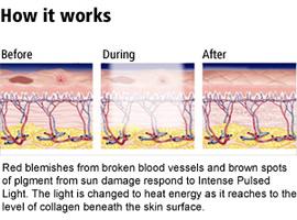 Glide into ‍Silky Skin: Understanding IPL Technology