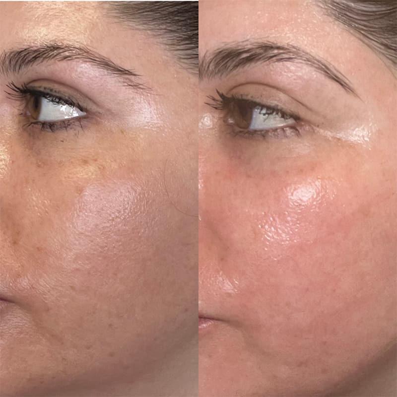 The Immediate Aftermath: What to ⁣Expect⁤ Post-Laser Smooth ⁢Treatment