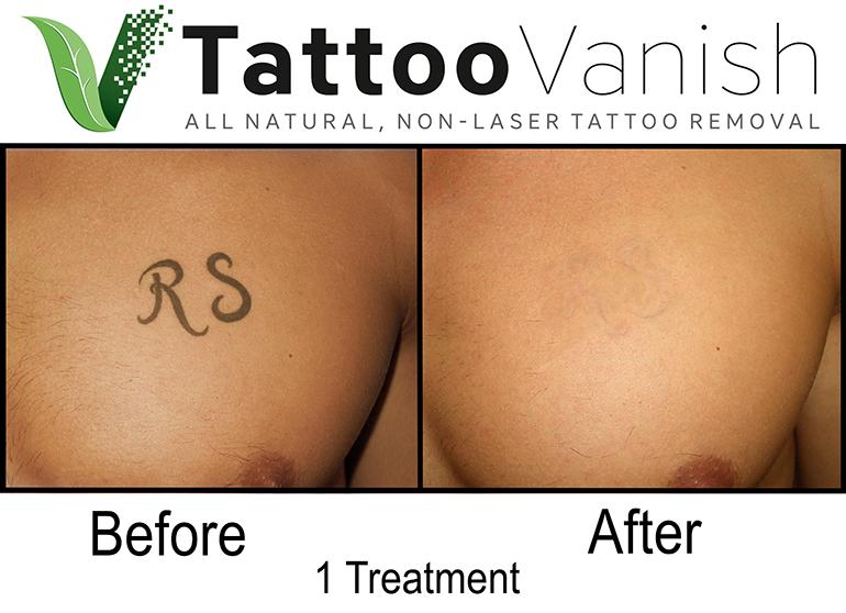 Budgeting for Fading Memories: Financial Tips for Affordable Tattoo Removal