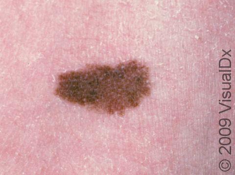 Understanding Melanocytic Nevi and Laser Hair Removal