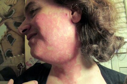 Facial Laser Hair Removal: Unmasking the Hidden Side Effects