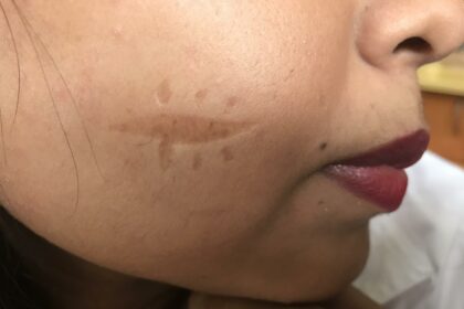 Laser Scars: Unveiling the Hidden Side of Hair Removal