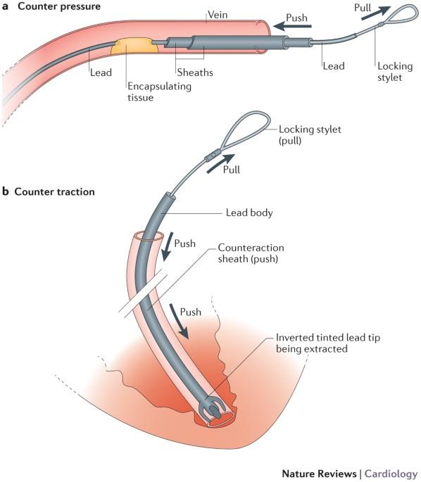 Transvenous Lead Extraction: Your Safety Score Guide