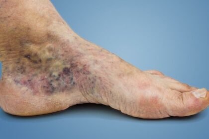 Healing Wounds: Venous Ulcer Care and Treatment Options 8 Healing Wounds: Venous Ulcer Care and Treatment Options