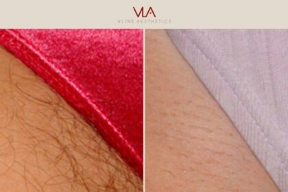 Unveil the Smooth: Bikini Laser Hair Removal Journey!