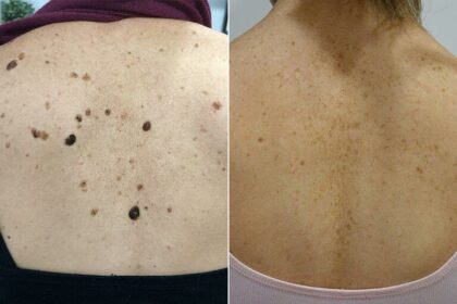 Effective Solutions for Removing Moles and Skin Lesions