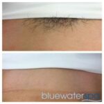 Lasered Brazilian: The Upsides and Downsides Explained
