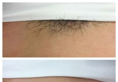 Lasered Brazilian: The Upsides and Downsides Explained