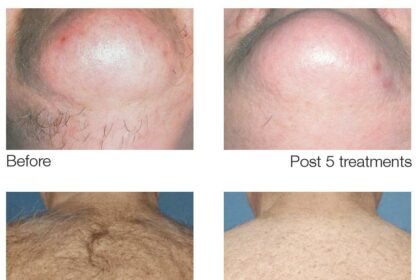 Post-Laser Hair Removal: Your Sun Avoidance Timeline 18 Post-Laser Hair Removal: Your Sun Avoidance Timeline
