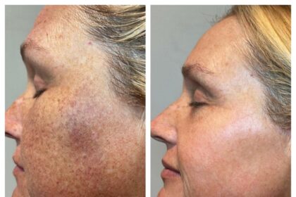 Post-IPL Care: Key Mistakes to Sidestep for Best Results 14 Post-IPL Care: Key Mistakes to Sidestep for Best Results