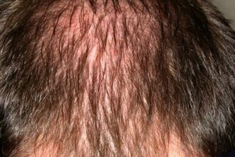 Shedding Light on Hair Loss: LLLT’s Shining Solution