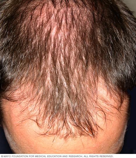 Shedding Light on Hair Loss: LLLT’s Shining Solution