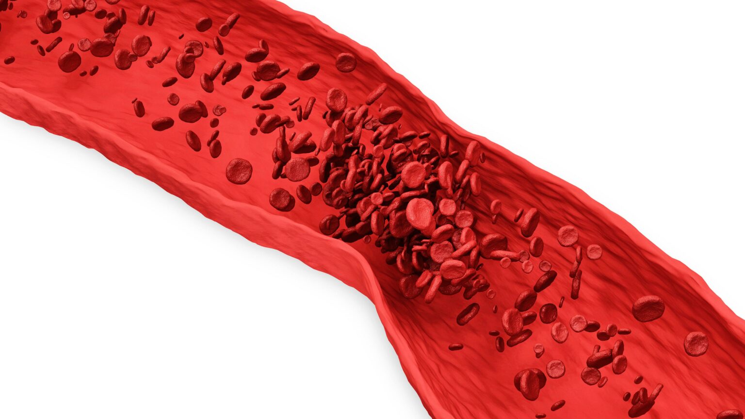 Untangling Clots: Effective Treatments for Leg DVT