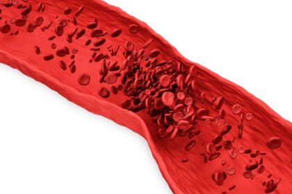 Untangling Clots: Effective Treatments for Leg DVT 20 Untangling Clots: Effective Treatments for Leg DVT