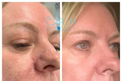 Laser Skin Resurfacing: Transform, Renew, and Revitalize