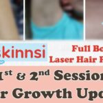 Smooth Moves: Navigating Skinnsi Laser Side Effects