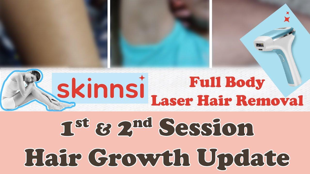Smooth Moves: Navigating Skinnsi Laser Side Effects