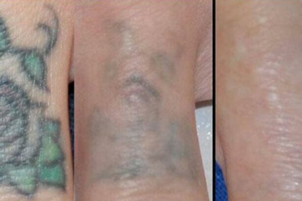 Erase the Past Faster: Your Guide to Quick Tattoo Removal