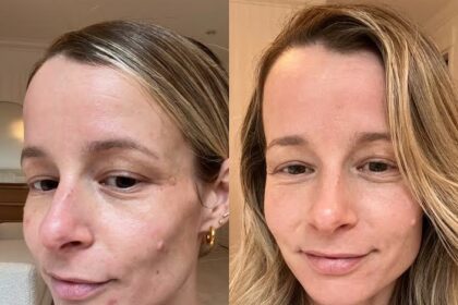 Mastering Post-Laser Glow: Essential Aftercare Insights 4 Mastering Post-Laser Glow: Essential Aftercare Insights