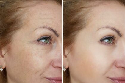 Laser Skin Resurfacing: Types, Conditions, and Tips