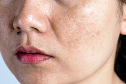 Brighten Up: Understanding and Treating Skin Dark Spots