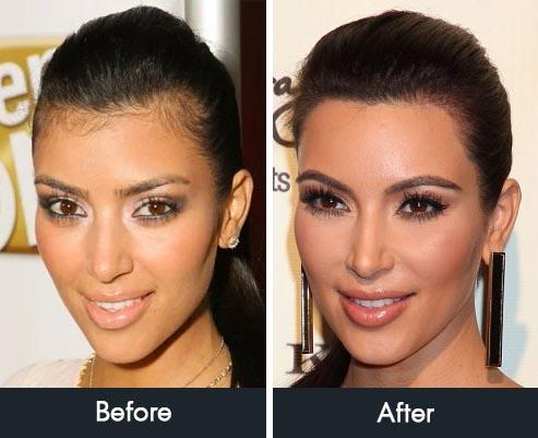Transform Your Look: Hairline Laser Magic Revealed!