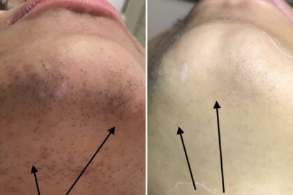 Post-Laser Hair Removal: Essential Do's and Don'ts Guide 10 Post-Laser Hair Removal: Essential Do’s and Don’ts Guide