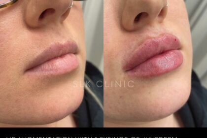 Smooth Sailing: 8 Expert Tips for Post-Lip Filler Care 6 Smooth Sailing: 8 Expert Tips for Post-Lip Filler Care
