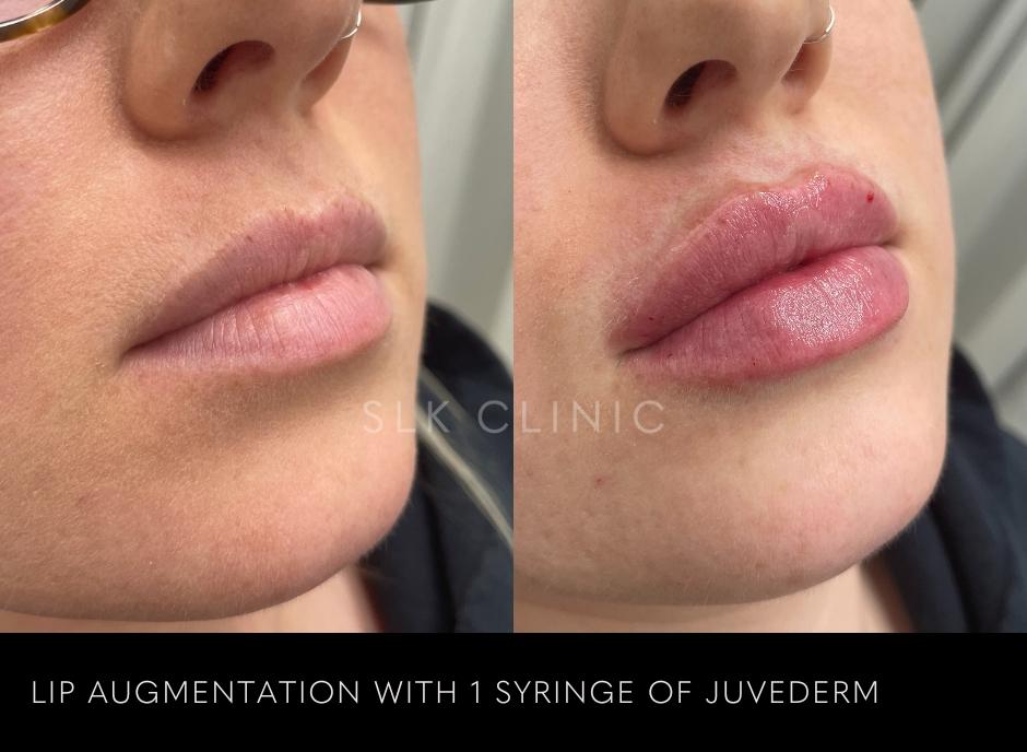 Smooth Sailing: 8 Expert Tips for Post-Lip Filler Care