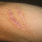 10 Key Insights Before Your Scar’s Laser Makeover