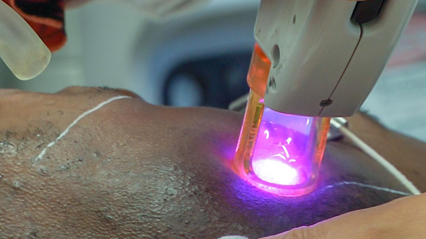 Post-Laser Hair Removal: Is Makeup a Friend or Foe?