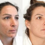 Glow Up: The Unexpected Perks of CO2 Laser Therapy!