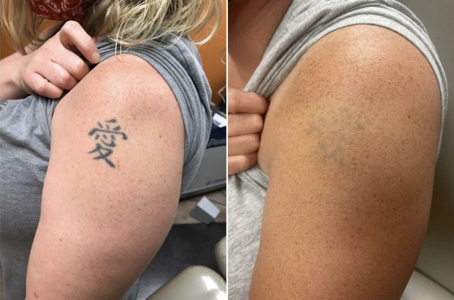 Erasing the Past: Tattoo Removal for Every Skin Tone