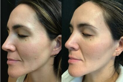 Pre-Laser Glow: Your Smooth Start Guide’s Checklist!