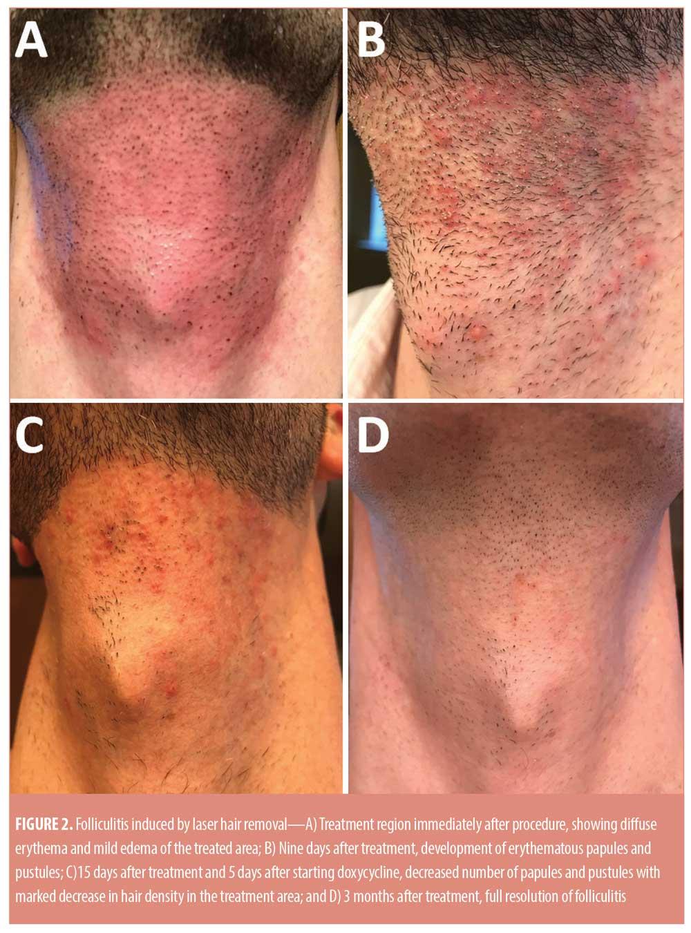 Glow and Care: Essential Tips for Post-Laser Hair Removal