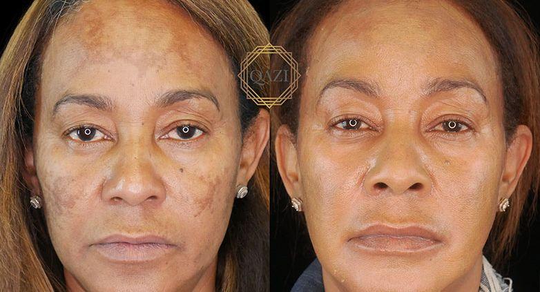 PicoSure Laser: A Gentle Touch for Asian Skin?