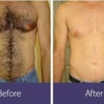 Smooth Sailing: Your Timeline to Laser Hair Results