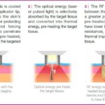 Smooth Sailing or Bumpy Ride? The Lowdown on ELOS Effects