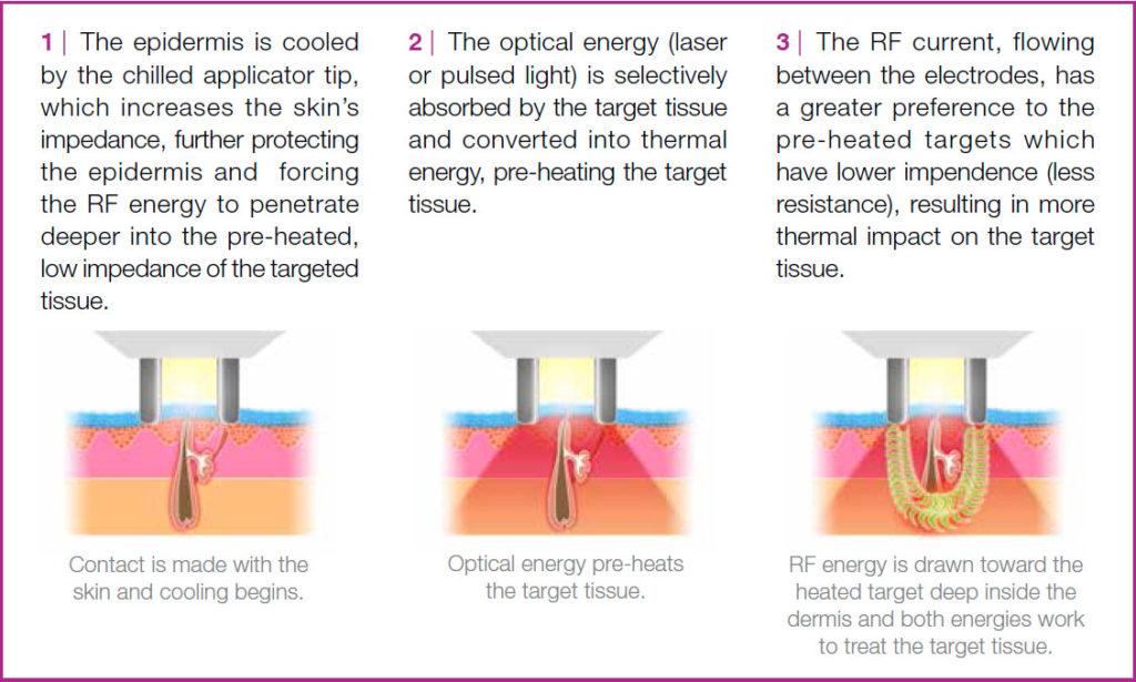Smooth Sailing or Bumpy Ride? The Lowdown on ELOS Effects