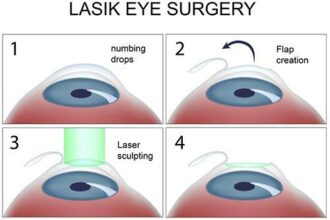 Laser Eye Surgery Aftercare: Top 10 Do’s and Don’ts