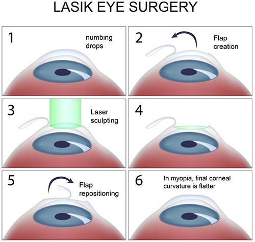 Laser Eye Surgery Aftercare: Top 10 Do’s and Don’ts