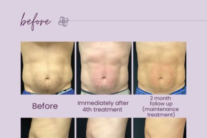 Is Emsculpt Safe? Uncovering Its Hidden Side Effects 10 Is Emsculpt Safe? Uncovering Its Hidden Side Effects