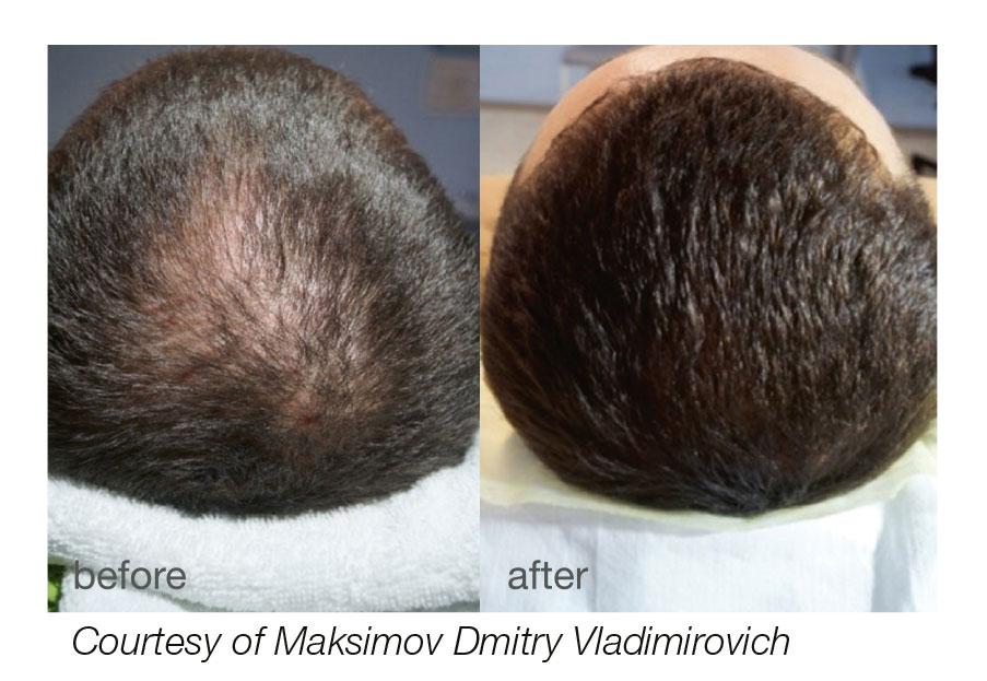 Smooth Sailing: Navigating Fotona Laser Hair Side Effects