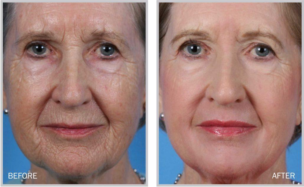Revitalize Your Look: Laser Skin Resurfacing Insights
