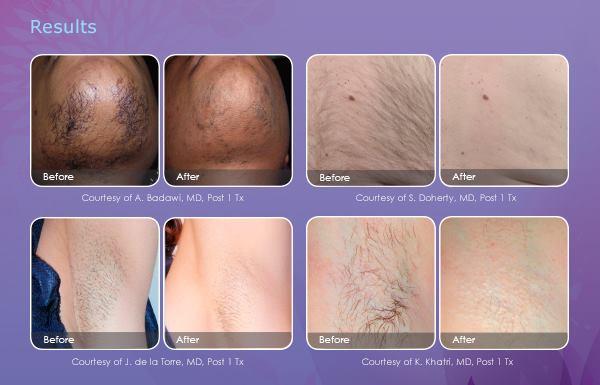 Smooth Transformations: Laser Bikini Line Makeover!