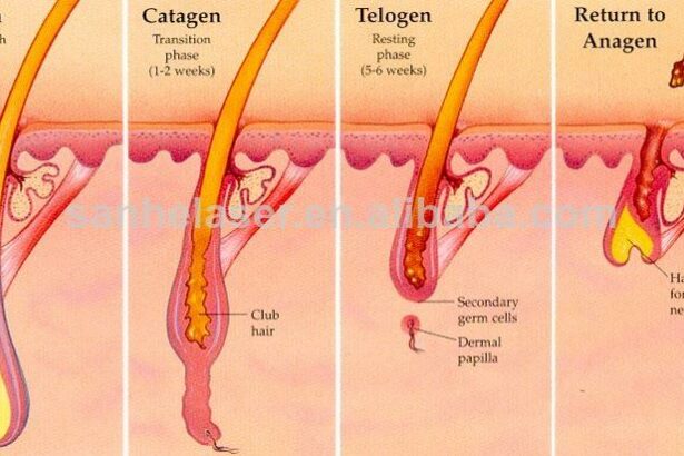 Permanent Laser Hair Removal: Cancer Myths and Truths