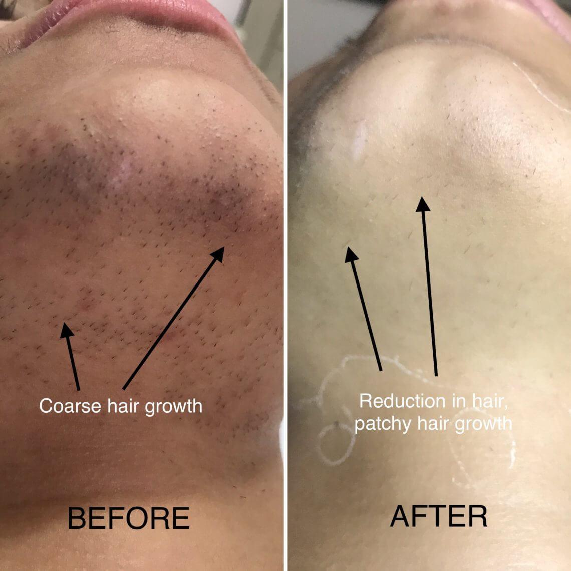 Post-Laser Hair Removal: When is Shower Time Safe?