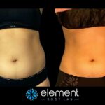 Achieve Your Dream Figure: Perfect CoolSculpting Results